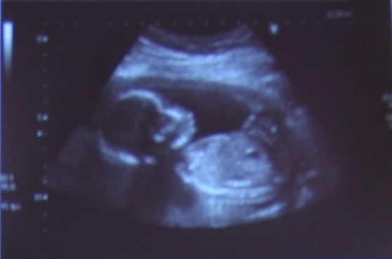 bump at 19 weeks